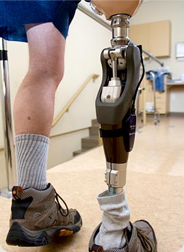 Wood artificial leg (prosthesis) for above knee amputee